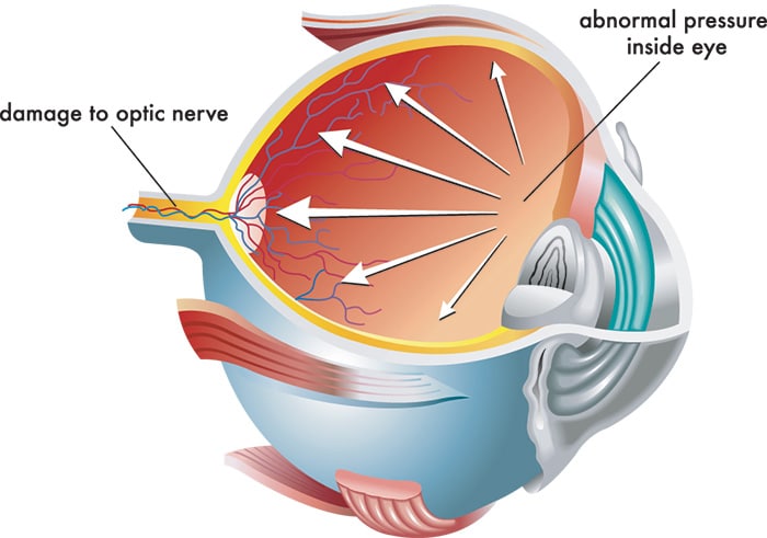Chart Showing How Adnormal Pressure in the Eye Affects the Optic Nerve